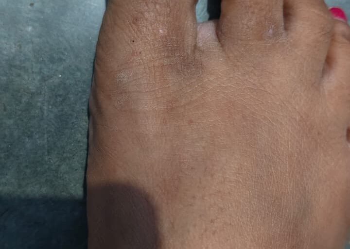 Warts for more than 3 years got cured