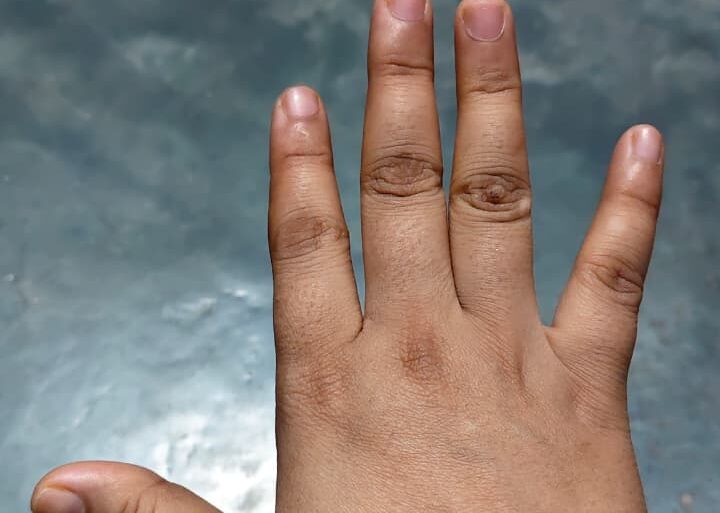 Warts for more than 3 years got cured