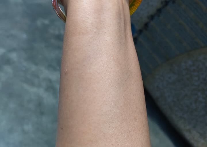 Warts for more than 3 years got cured