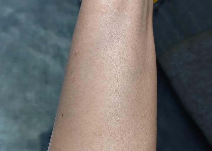 Warts for more than 3 years got cured