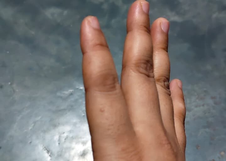 Warts for more than 3 years got cured