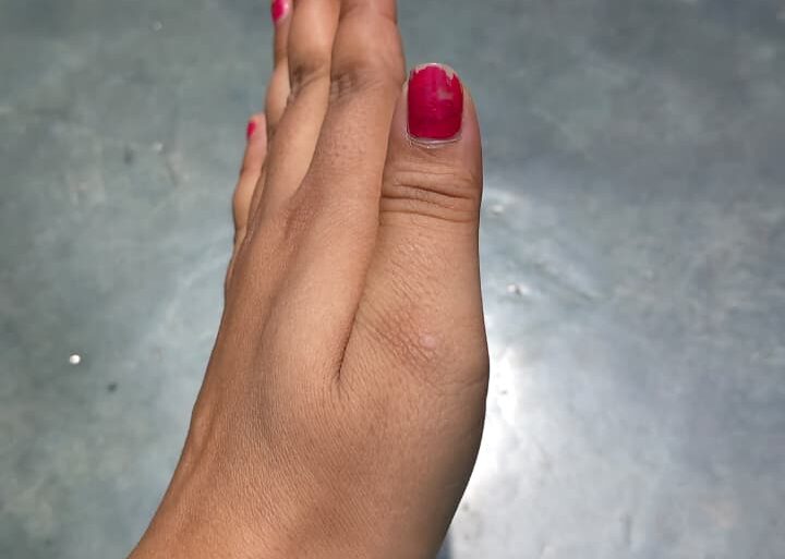 Warts for more than 3 years got cured