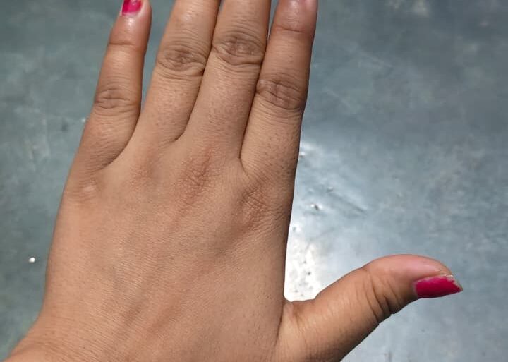 Warts for more than 3 years got cured