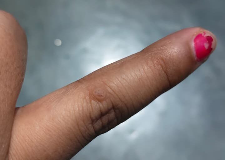 Warts for more than 3 years got cured
