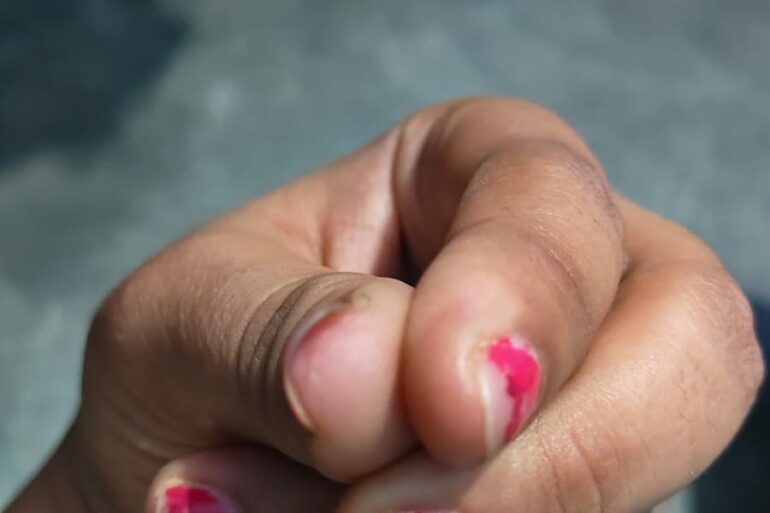 Warts for more than 3 years got cured