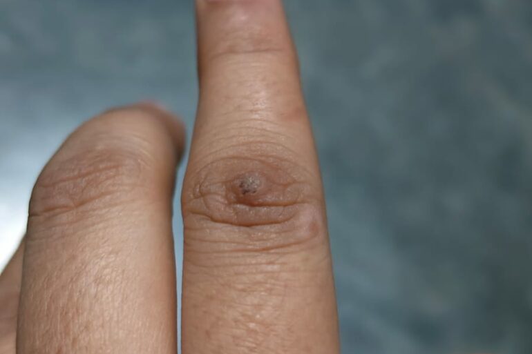 Warts for more than 3 years got cured