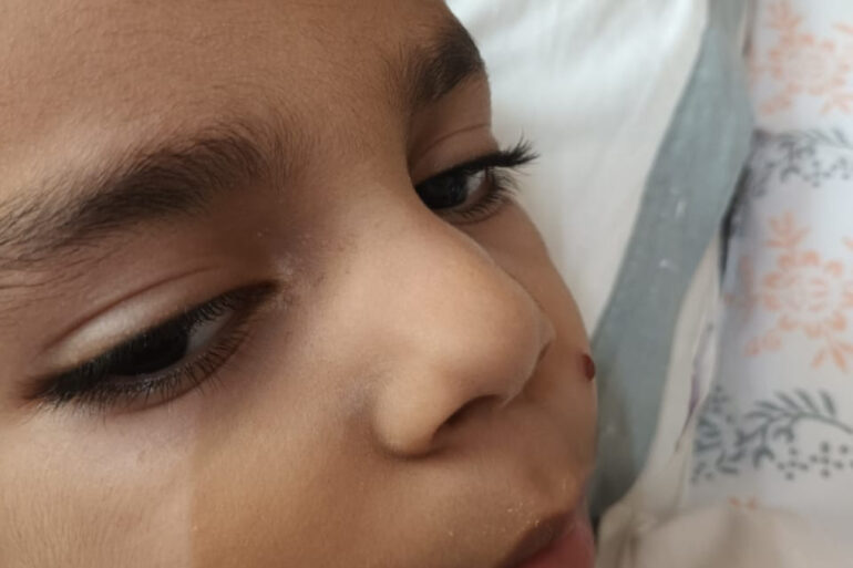 Facial Warts in a 5-Year-Old Child – Online Treatment from Bijnor