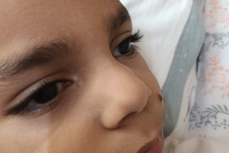 Facial Warts in a 5-Year-Old Child – Online Treatment from Bijnor