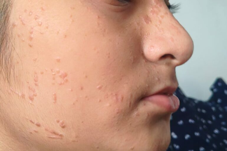 Paramedic Recovers from 4-Year Flat Warts in 14 Days via Medicinre transmission