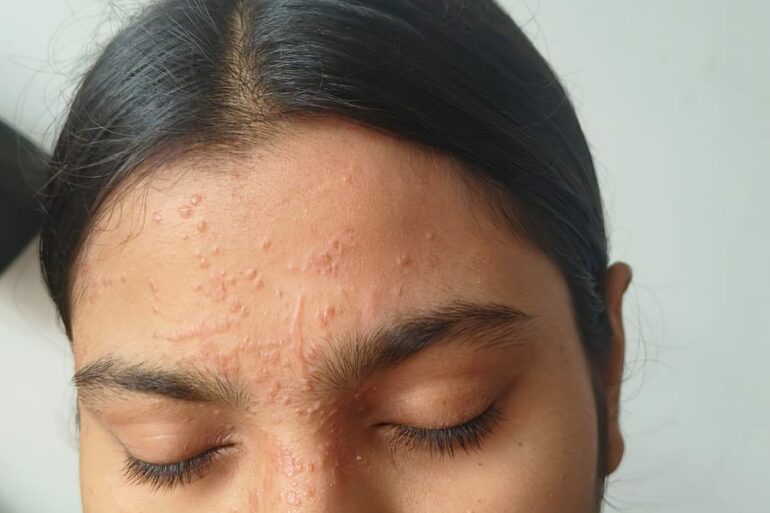 Paramedic Recovers from 4-Year Flat Warts in 14 Days via Medicinre transmission