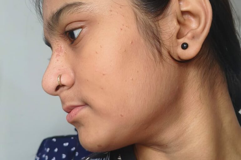 Paramedic Recovers from 4-Year Flat Warts in 14 Days via Medicinre transmission