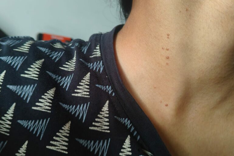 Paramedic Recovers from 4-Year Flat Warts in 14 Days via Medicinre transmission