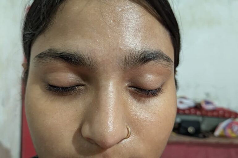 Paramedic Recovers from 4-Year Flat Warts in 14 Days via Medicinre transmission