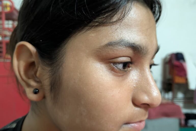 Paramedic Recovers from 4-Year Flat Warts in 14 Days via Medicinre transmission