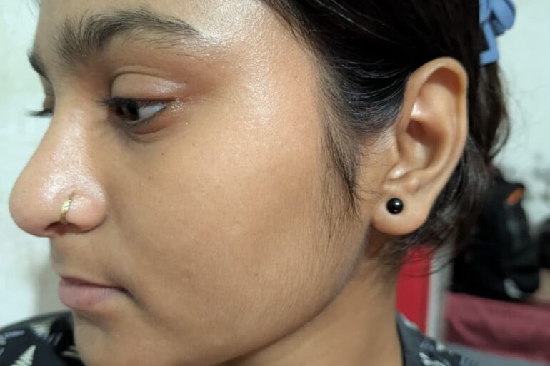 Paramedic Recovers from 4-Year Flat Warts in 14 Days via Medicinre transmission