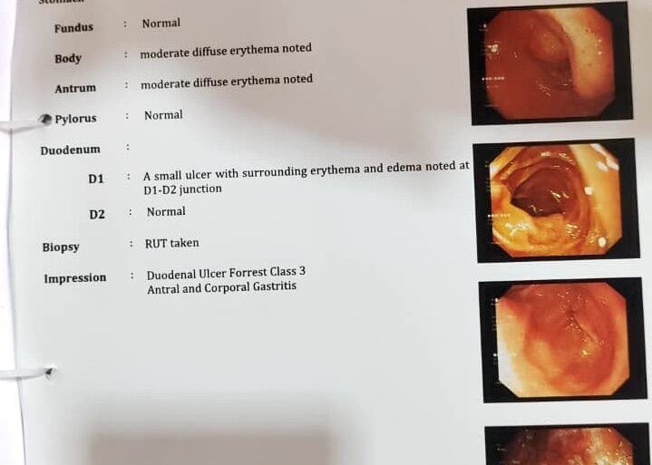 Wonderful improvement in 4 years long trouble of Peptic ulcer and shoulder dislocation