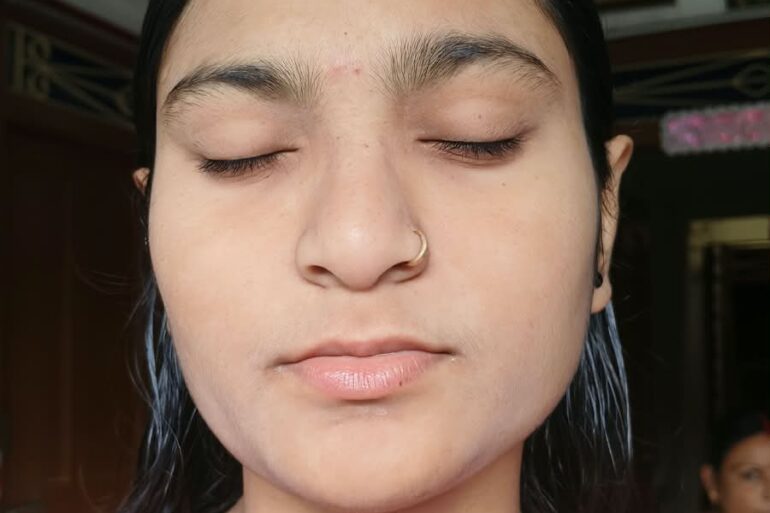 Paramedic Recovers from 4-Year Flat Warts in 14 Days via Medicinre transmission