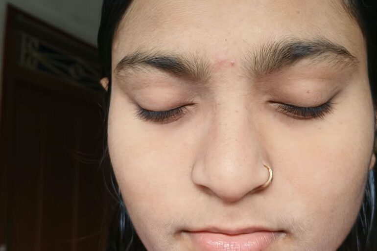 Paramedic Recovers from 4-Year Flat Warts in 14 Days via Medicinre transmission