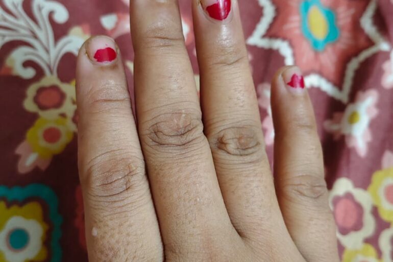 Warts for more than 3 years got cured