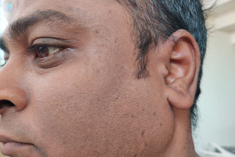 WARTS SINCE 2017 GETTING BETTER IN 21 DAYS- AMZING RECOVERY