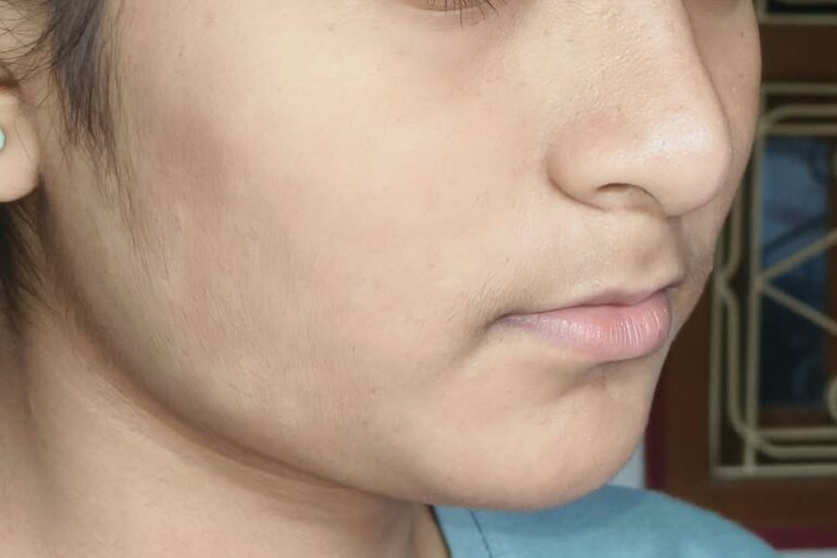 Paramedic Recovers from 4-Year Flat Warts in 14 Days via Medicinre transmission