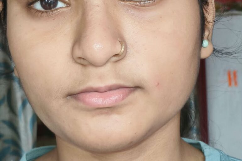 Paramedic Recovers from 4-Year Flat Warts in 14 Days via Medicinre transmission