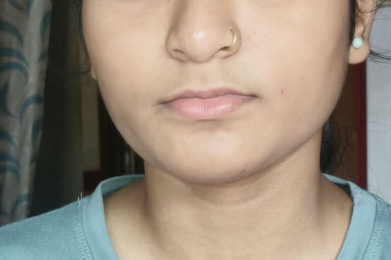 Paramedic Recovers from 4-Year Flat Warts in 14 Days via Medicinre transmission