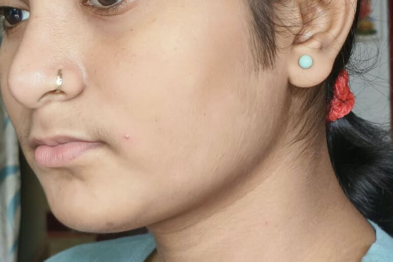 Paramedic Recovers from 4-Year Flat Warts in 14 Days via Medicinre transmission