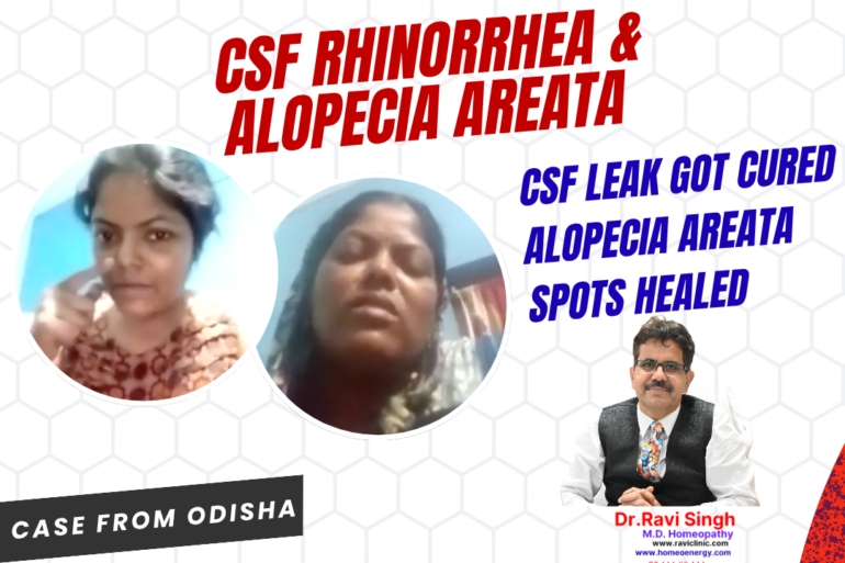Severe CSF Rhinorrhea and Autoimmune Alopecia Areata Resolved via Homeopathy