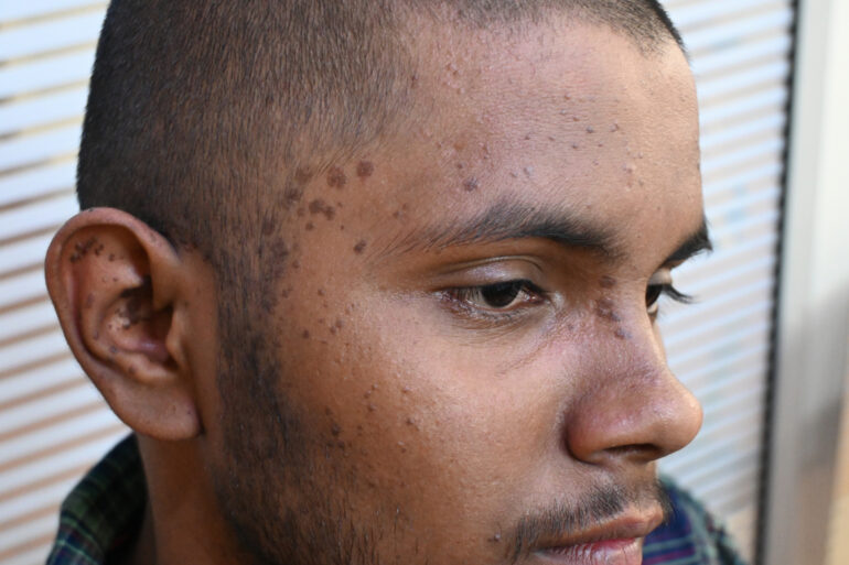 Flat warts For 4 years Got cured in 4 months- Case From Jaunpur