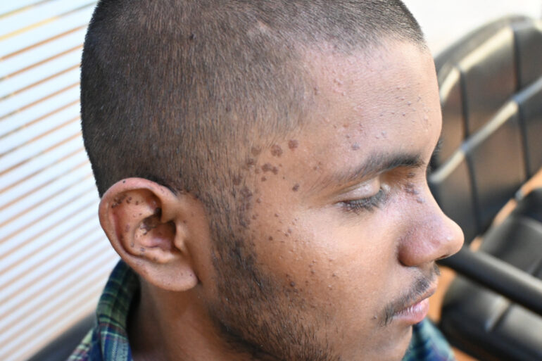 Flat warts For 4 years Got cured in 4 months- Case From Jaunpur