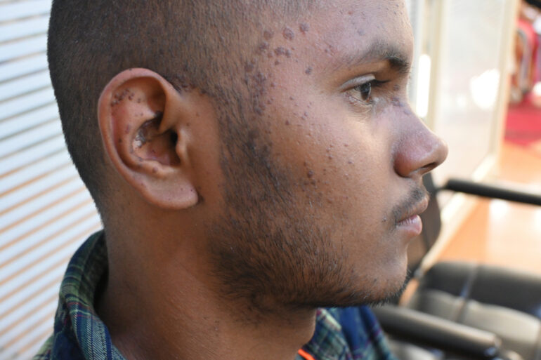 Flat warts For 4 years Got cured in 4 months- Case From Jaunpur