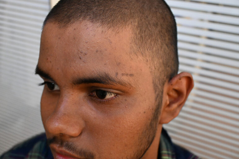 Flat warts For 4 years Got cured in 4 months- Case From Jaunpur