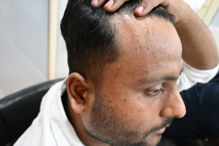 Flat warts since 2017 Got cured with classical Homeopathy
