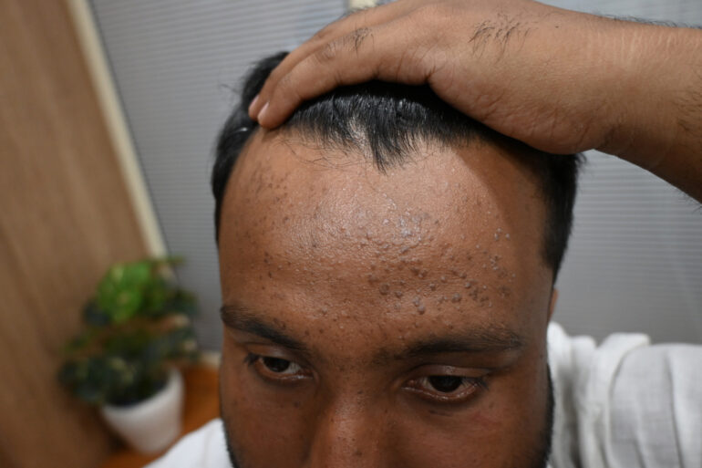 Flat warts since 2017 Got cured with classical Homeopathy