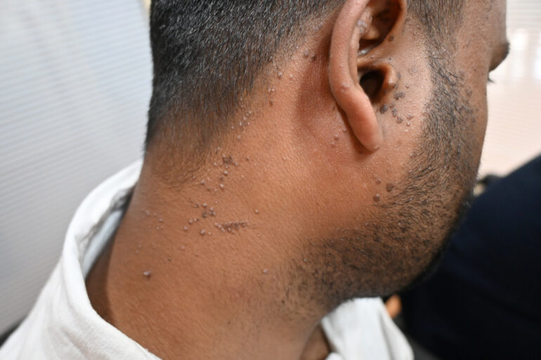 Flat warts since 2017 Got cured with classical Homeopathy