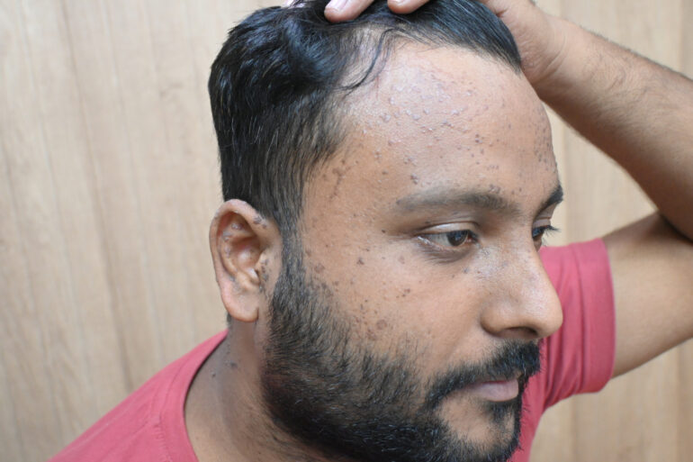 Flat warts since 2017 Got cured with classical Homeopathy