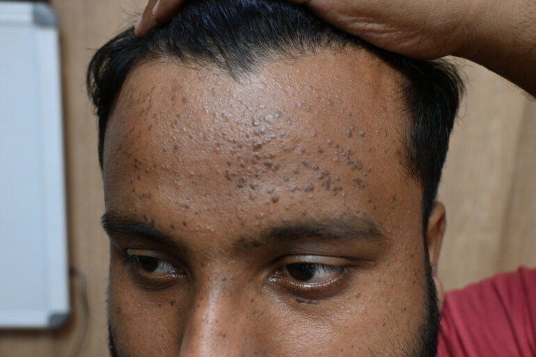 Flat warts since 2017 Got cured with classical Homeopathy