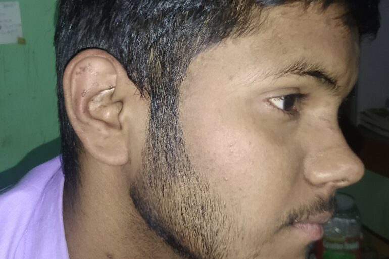 Flat warts For 4 years Got cured in 4 months- Case From Jaunpur
