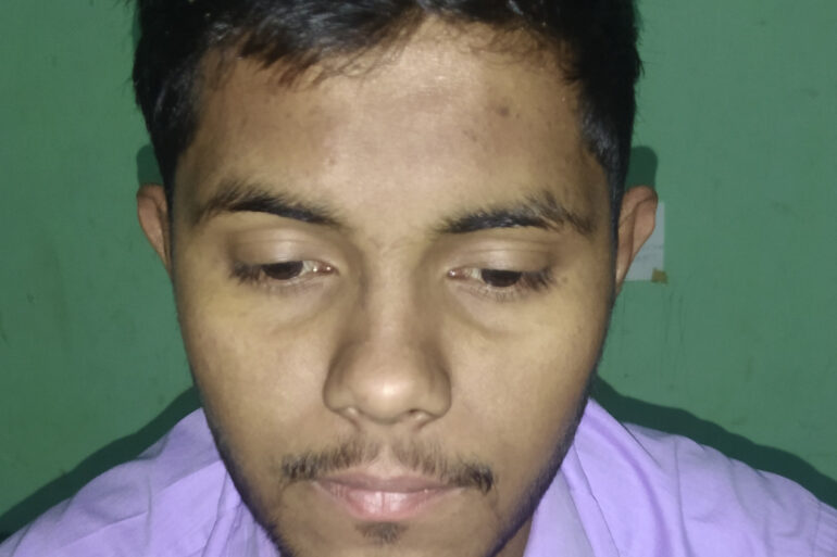 Flat warts For 4 years Got cured in 4 months- Case From Jaunpur
