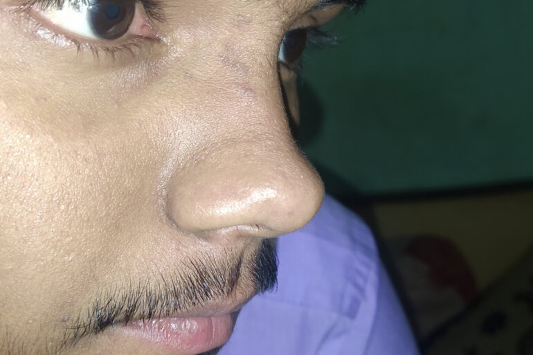 Flat warts For 4 years Got cured in 4 months- Case From Jaunpur