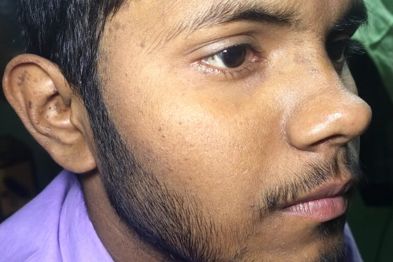 Flat warts For 4 years Got cured in 4 months- Case From Jaunpur