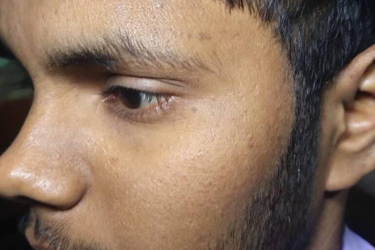 Flat warts For 4 years Got cured in 4 months- Case From Jaunpur