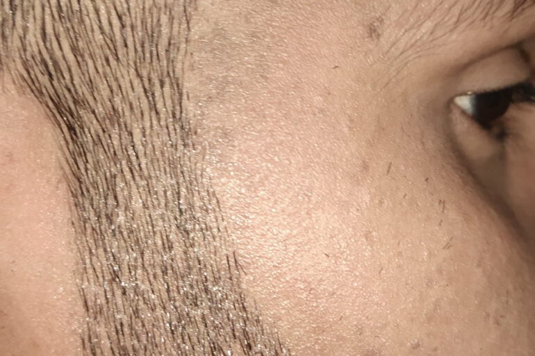 Flat warts For 4 years Got cured in 4 months- Case From Jaunpur