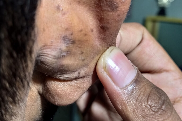 Flat warts For 4 years Got cured in 4 months- Case From Jaunpur
