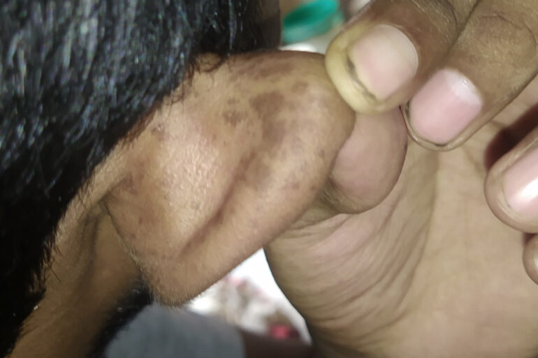Flat warts For 4 years Got cured in 4 months- Case From Jaunpur
