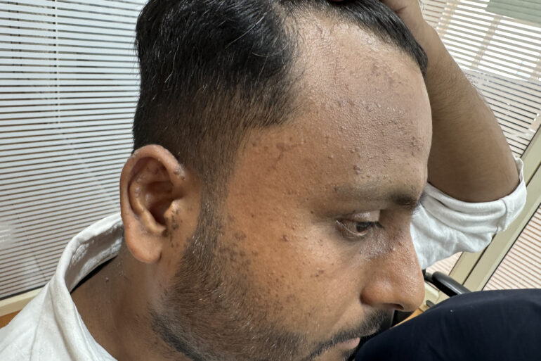 Flat warts since 2017 Got cured with classical Homeopathy