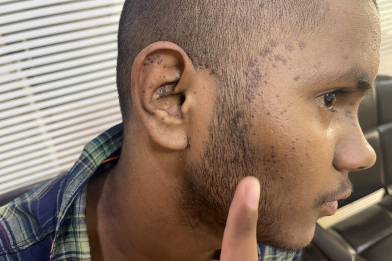 Flat warts For 4 years Got cured in 4 months- Case From Jaunpur