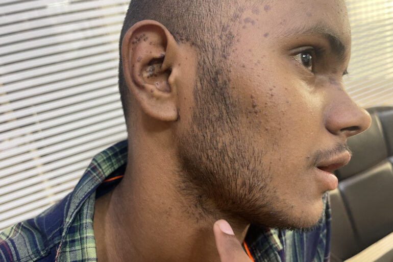 Flat warts For 4 years Got cured in 4 months- Case From Jaunpur