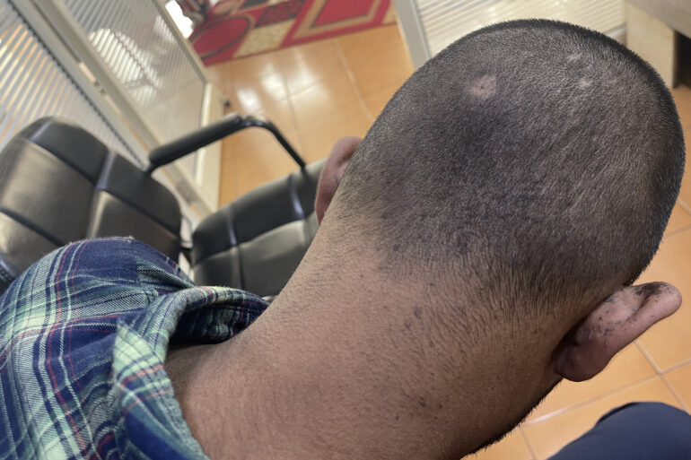 Flat warts For 4 years Got cured in 4 months- Case From Jaunpur